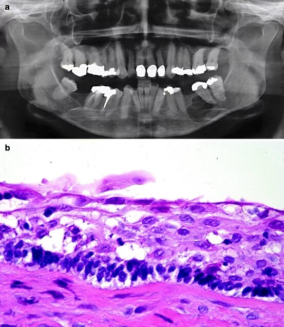 Рак нижней челюсти фото Odontogenic Tumours Pocket Dentistry