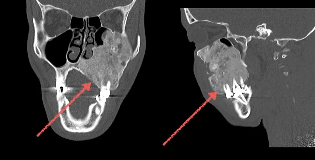 Рак нижней челюсти фото Гранулема височной кости
