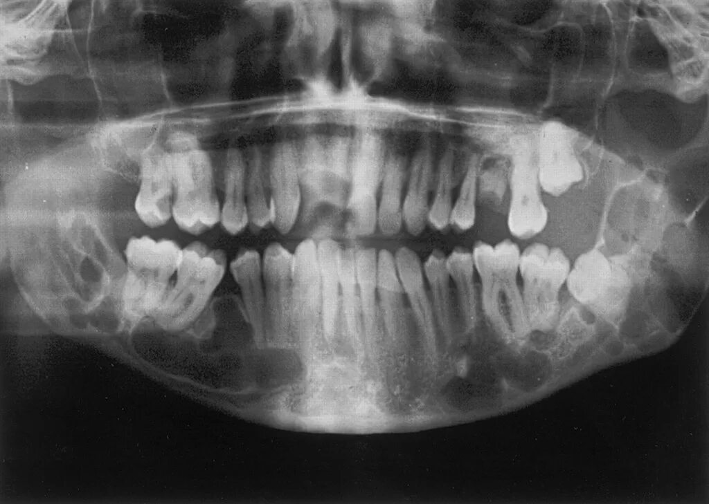 Рак нижней челюсти фото Tumor Odontogênico Ceratocístico- Sindrome de Gorlin-Goltz. Flickr