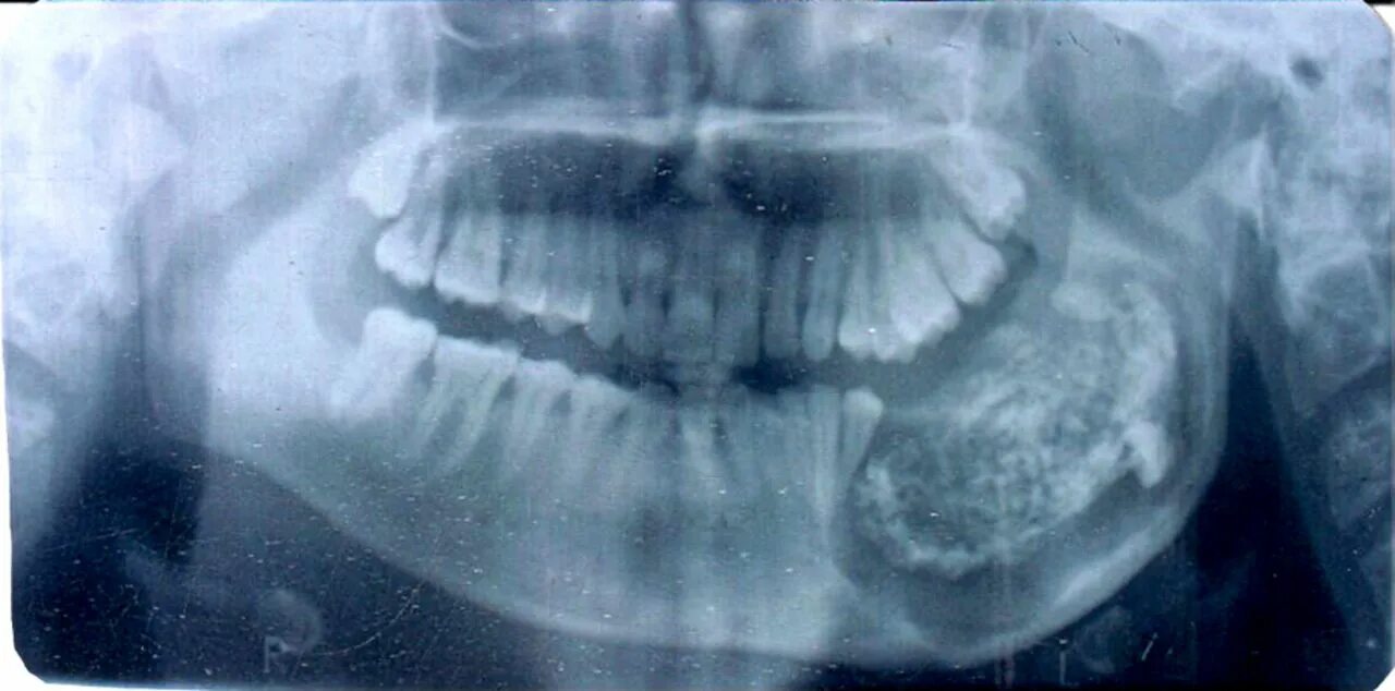 Рак нижней челюсти фото Complex composite odontoma and World Record teeth - BMJ Case Reports blog