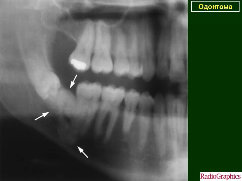Рак нижней челюсти фото Стоматология. Одонтома. + Портал радиологов