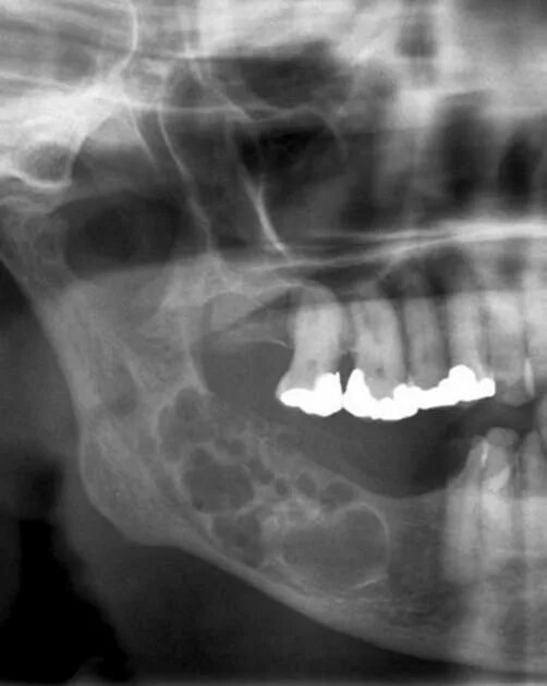 Рак нижней челюсти симптомы фото Ameloblastoma Radiology Case Radiopaedia.org Radiology, Bone diseases, Dental