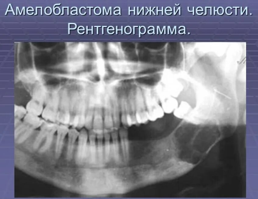 Рак нижней челюсти симптомы фото Причины и факторы риска онкологии рта - злокачественные опухоли полости рта Нова