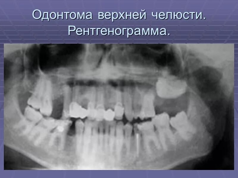 Рак нижней челюсти симптомы фото Доброкачественные одонтогенные и неодонтогенные опухоли челюстей (амелобластома,