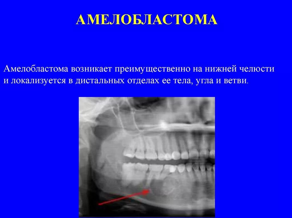 Рак нижней челюсти симптомы и признаки фото Лицевые боли - презентация онлайн