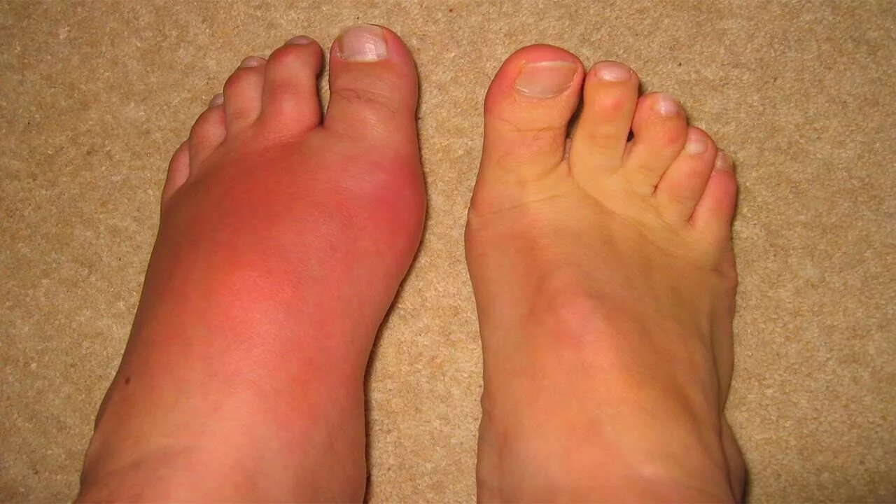 Рак ноги симптомы у женщин фото Gout Gout causes How to treat gout Home Remedies for Gout - YouTube