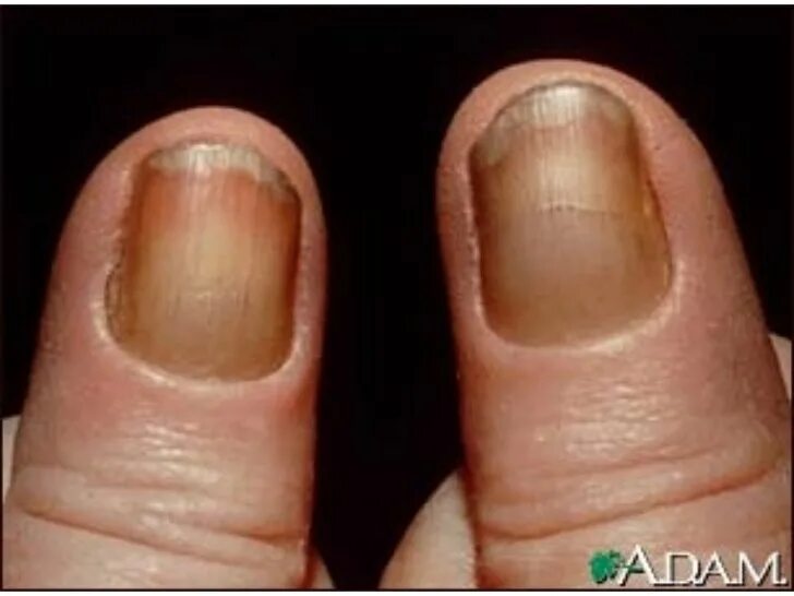 Рак ногтей на руках фото начальная стадия brown finger nails Yellow nail syndrome, Yellow nails, Nail health