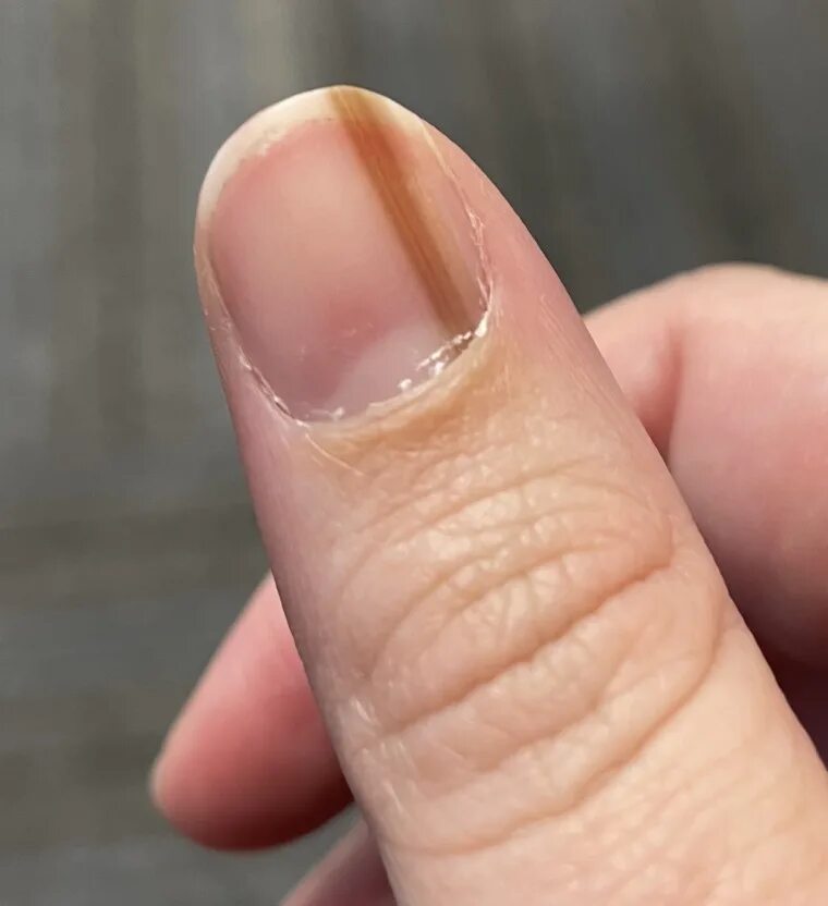 Рак ногтя фото Subungual Melanoma: Tan Streak On Woman's Nail Was Skin Cancer