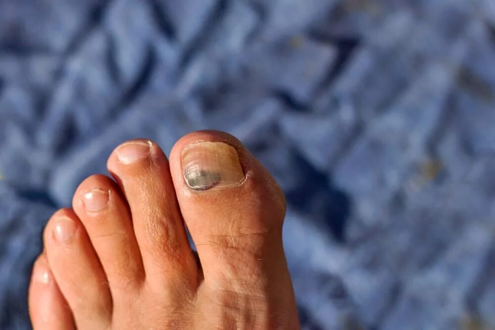 Рак ногтя на ноге фото The nine types of toenails you will find in the running scene... - Canadian Runn