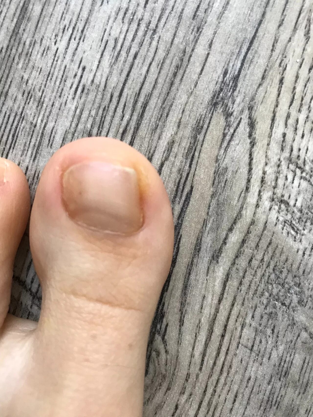 Hutchinson's Nail Sign - NEJM Nail signs, Black nails, Toe nails