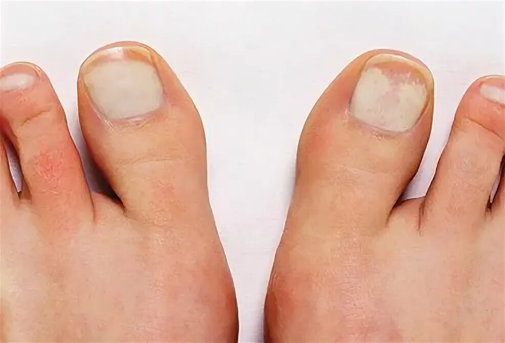 Рак ногтя на ноге симптомы фото Why Are My Toenails That Color? White spots on toenails, Toe nail color, Toe nai