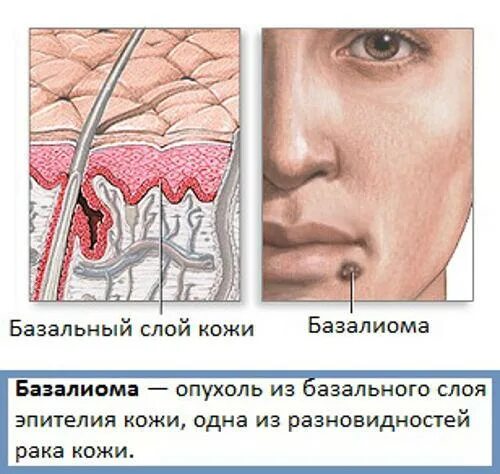 Рак носа начальная стадия фото Базалиома носа: поражения слизистой кожи, операция по удалению на начальной стад