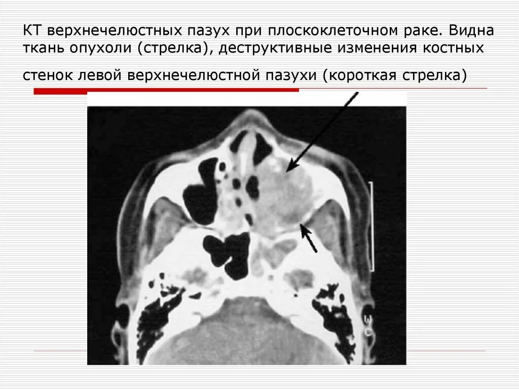 Рак носа симптомы и признаки фото Рак полости носа и придаточных пазух