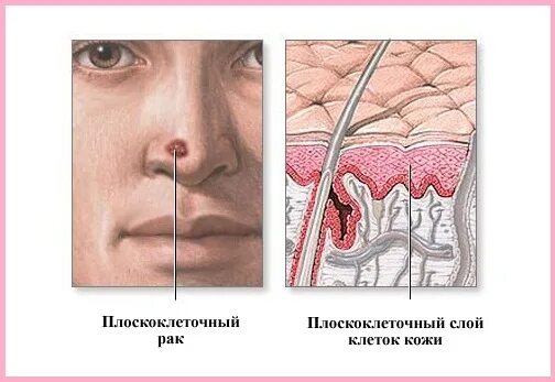 Рак носа симптомы и признаки фото Базалиома носа: диагностика, симптомы и лечение fr-dc.ru