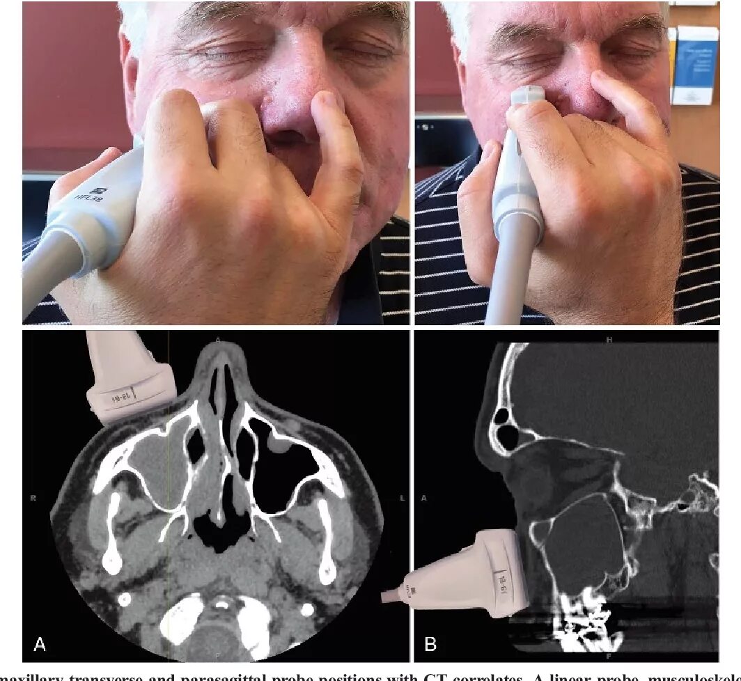 Рак носа симптомы и признаки фото Point-of-Care Sinus Ultrasound: Impact Within a Large Internal Medicine Clinic a