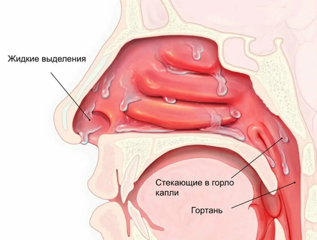 Рак носоглотки симптомы фото Насморк и заложено горло: найдено 29 изображений