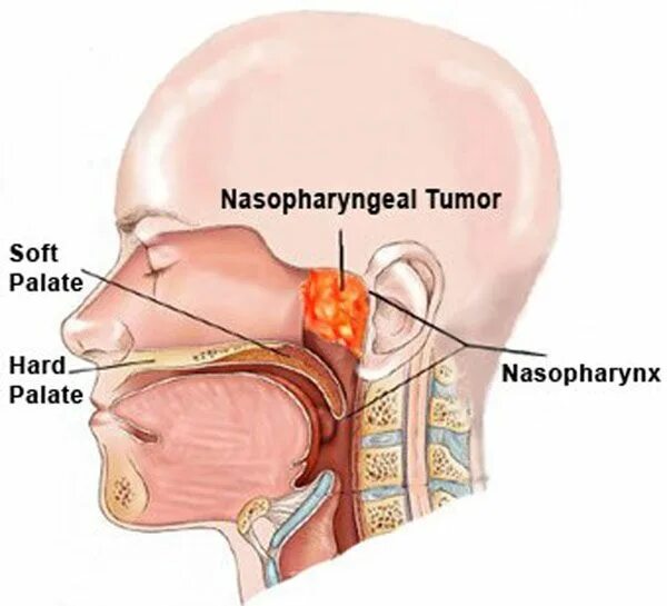 Рак носоглотки симптомы фото Pin on Oral and Maxillofacial Surgery