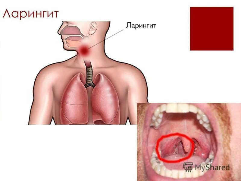 Рак носоглотки симптомы и признаки фото Ларингит у детей: 5 первых признаков, 6 причин, 7 симптомов, лечение в 1, 2, 3 г