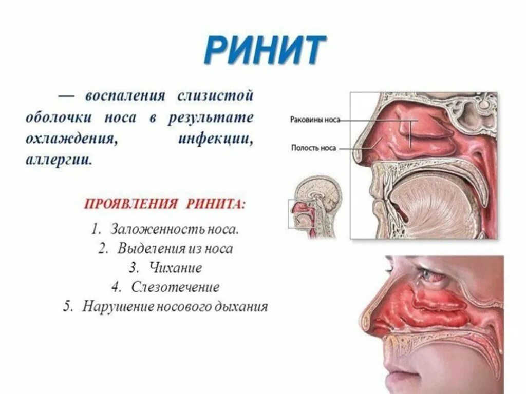 Рак носоглотки симптомы и признаки фото Заболевание ринит симптомы