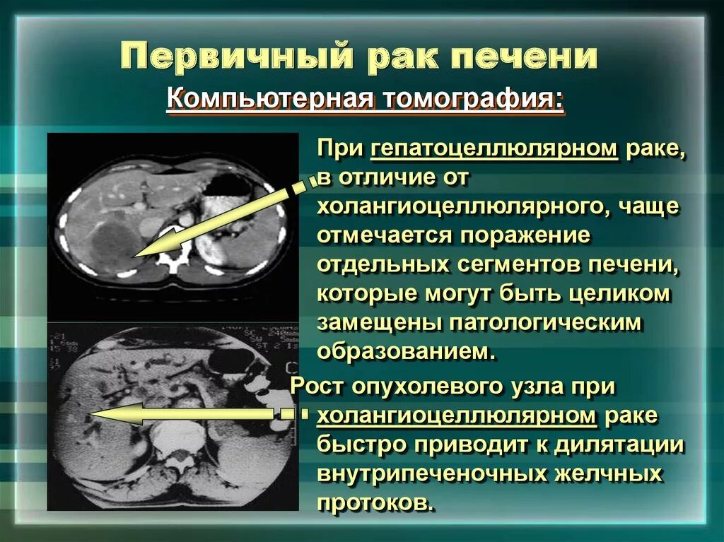 Рак печени 4 стадия фото Рак печени первая стадия симптомы: найдено 76 картинок