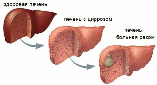 Рак печени 4 стадия фото Билиарный цирроз печени: причины, симптомы и лечение в статье гепатолога Глазков