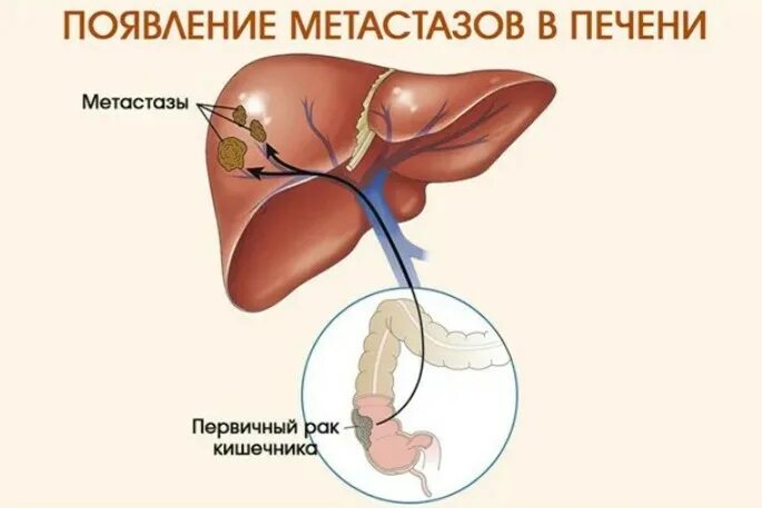 Рак печени 4 стадия фото Почему появляются метастазы в печени и как их лечить