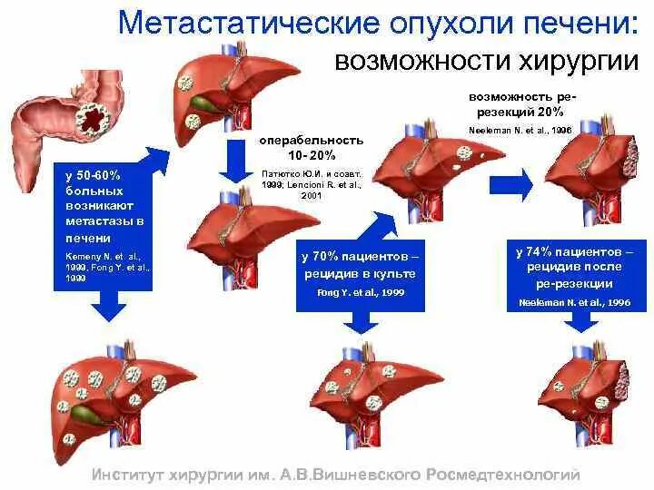 Рак печени 4 стадия фото Что значит метастаза печени: найдено 80 изображений