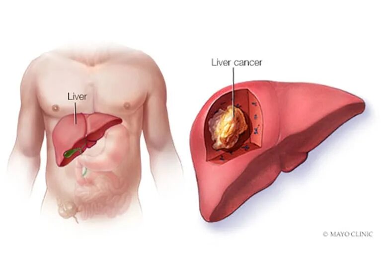 Рак печени 4 стадия фото Use of comprehensive multigene panel testing for patients with HBC - Mayo Clinic