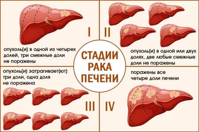 Рак печени 4 стадия фото Рак печени - симптомы, виды, лечение, диагностика в ФНКЦ ФМБА России