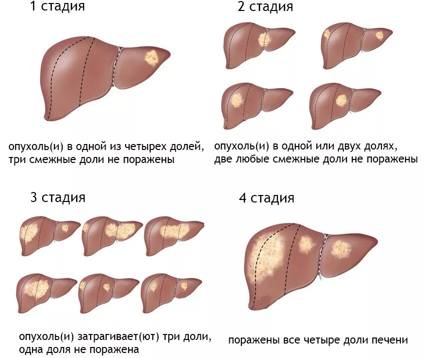 Рак печени 4 стадия фото Рак печени