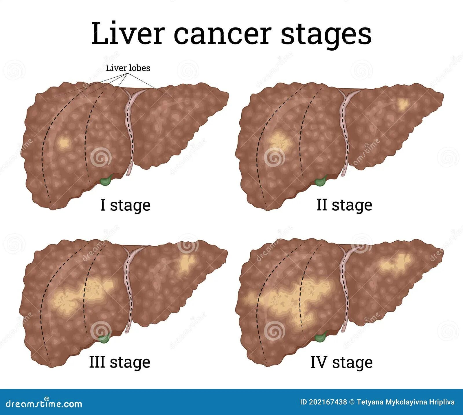 Рак печени 4 стадия фото Liver cancer stages stock vector. Illustration of destruction - 202167438