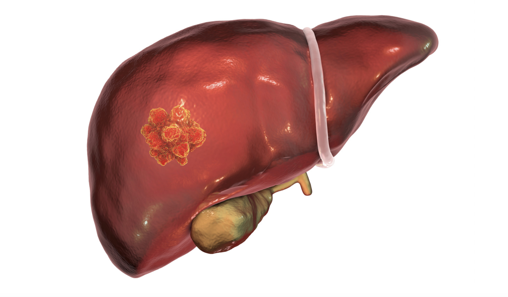 Рак печени 4 стадия фото Study Finds Folfirinox is Well Tolerated, Potentially Effective in First-Line Tr