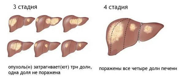 Рак печени 4 стадия фото Лечение рака печени - новости отделения онкологии СПбМГУ