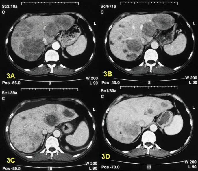 Рак печени 4 стадия фото Local treatment in unresectable hepatic metastases of carcinoid tumors: Experien