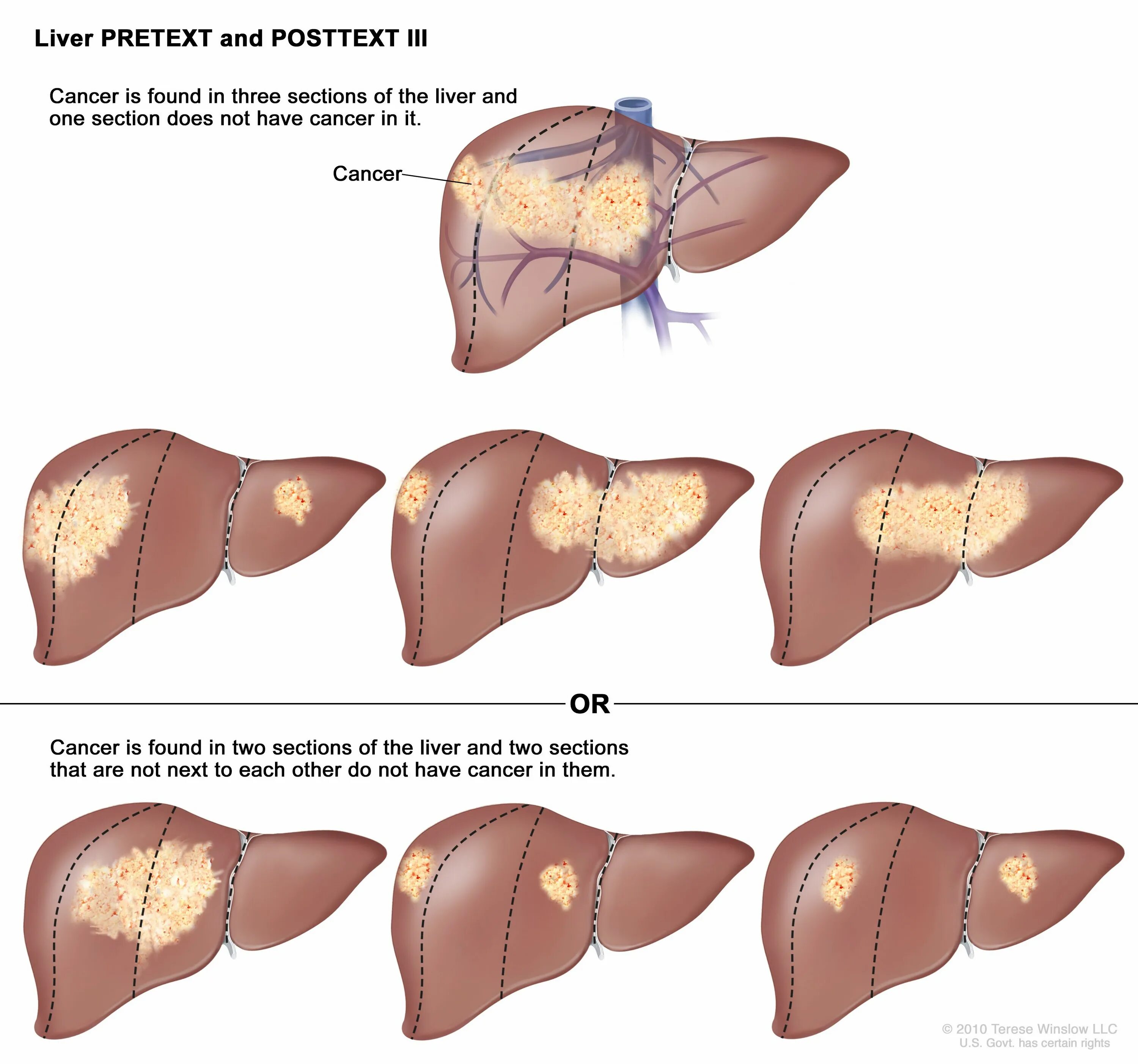 Рак печени 4 стадия фото Childhood Hepatocellular Carcinoma - NCI