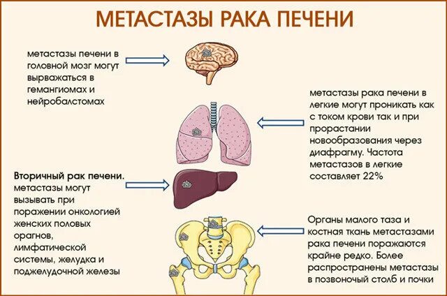 Рак печени фото Метастазы в печени: симптомы перед смертью, прогноз срока жизни и лечение. ПРО В