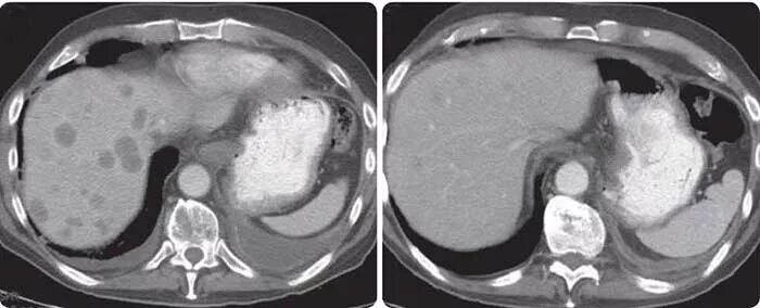 Study Finds Folfirinox is Well Tolerated, Potentially Effective in First-Line Tr