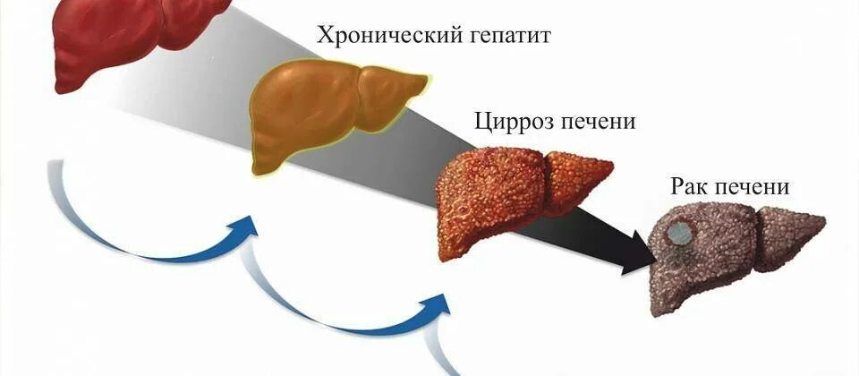 Рак печени фото больных 28 юля - Всемирный день борьбы с гепатитом - Центр охраны материнства и детства 