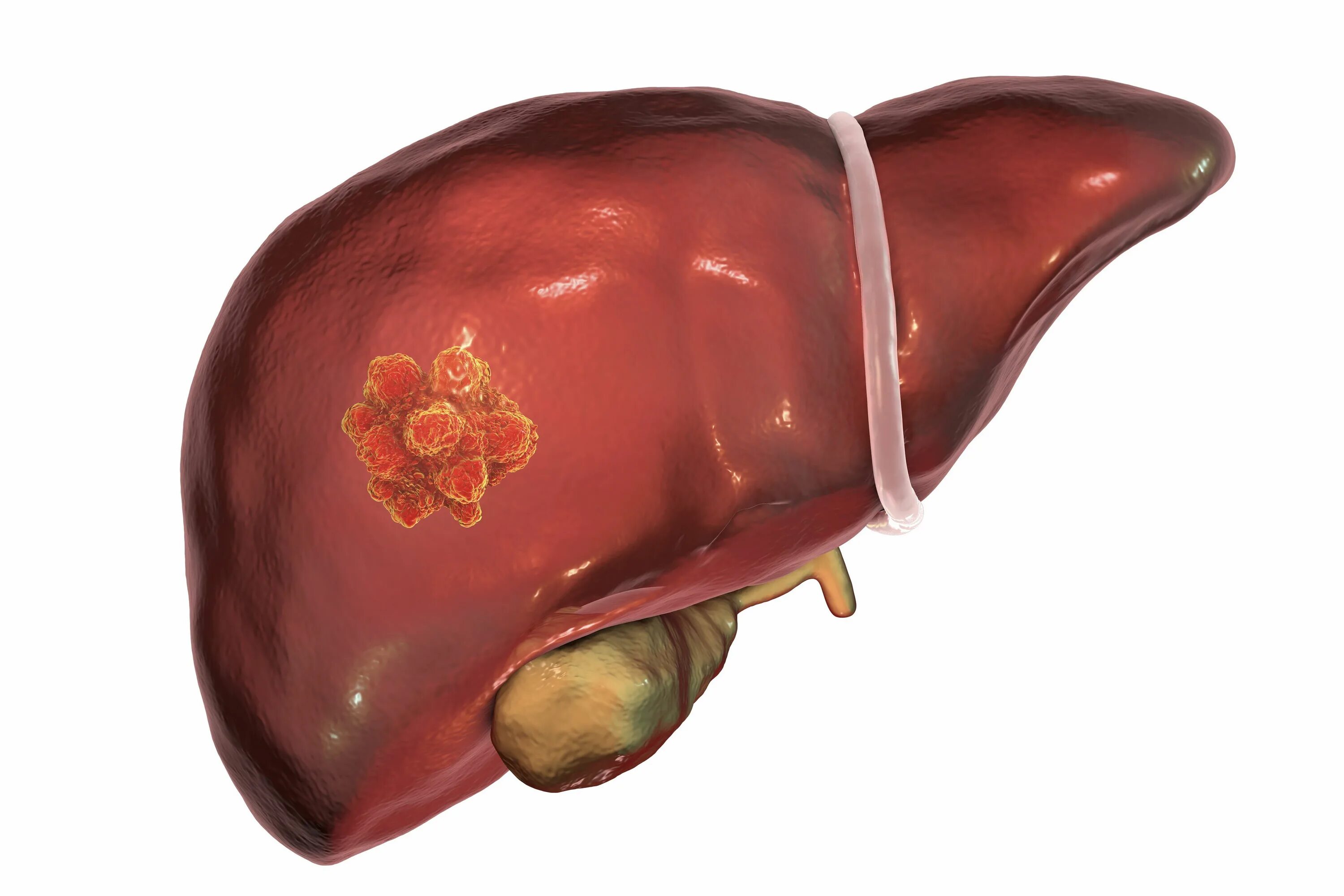 Рак печени фото больных Effective Transarterial Chemoembolization, Lenvatinb, and Sintilimab Combo in HC