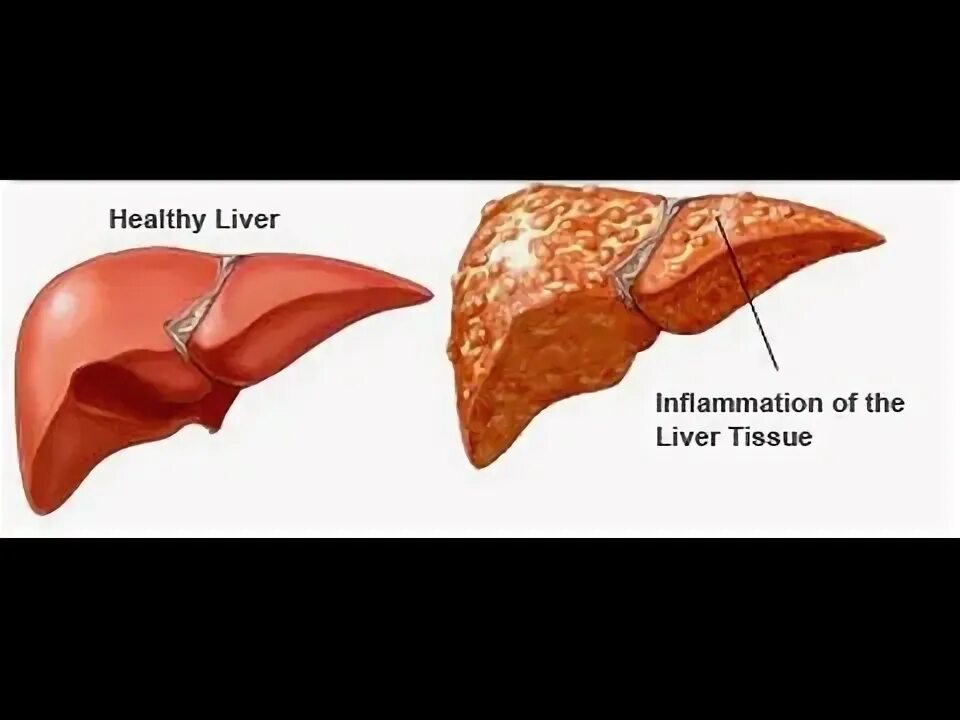 Рак печени фото людей HEPATITIS DIABETICA - YouTube