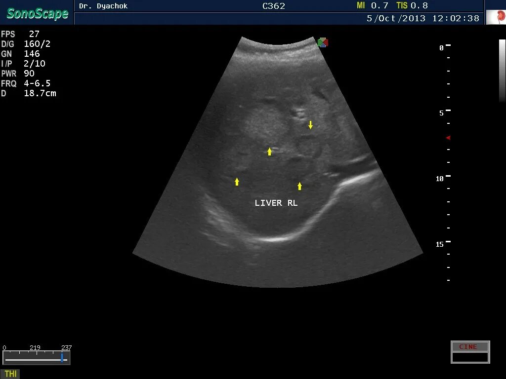 Рак печени на узи фото Онкология