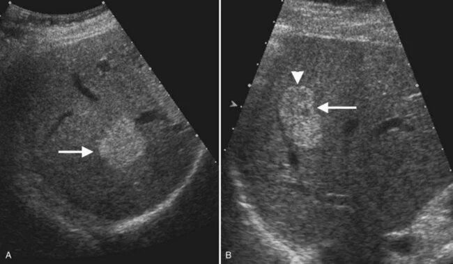 Рак печени на узи фото Ultrasound of the liver, biliary tract, and pancreas Ultrasound, Medical ultraso