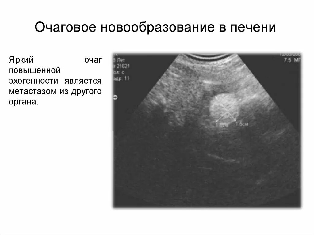 Рак печени на узи фото Очаговое образование что это такое - найдено 81 картинок