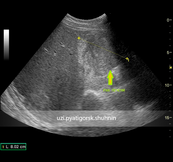 Рак печени на узи фото Солнечный угар - УЗИ Пятигорск Шухнин Р. Е.