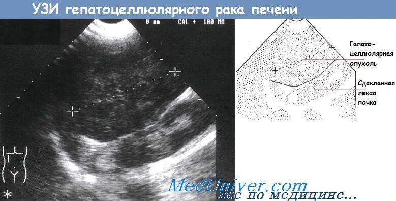 Рак печени на узи фото Гепатома (первичный гепатоцеллюлярный рак) - диагностика