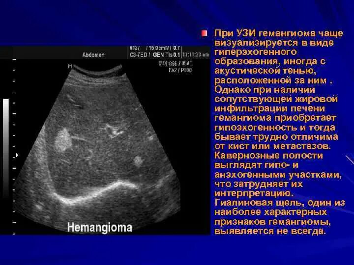 Рак печени на узи фото Объемное образование правой доли печени - найдено 90 картинок