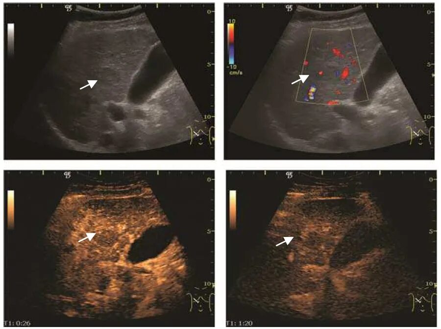 Рак печени на узи фото File:Ultrasonography of a dysplastic nodule.jpg - Wikipedia