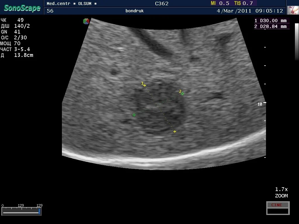 Рак печени на узи фото УЗИ БРЮШНОЙ ОБЛАСТИ - Медицинский центр "OLSUM"