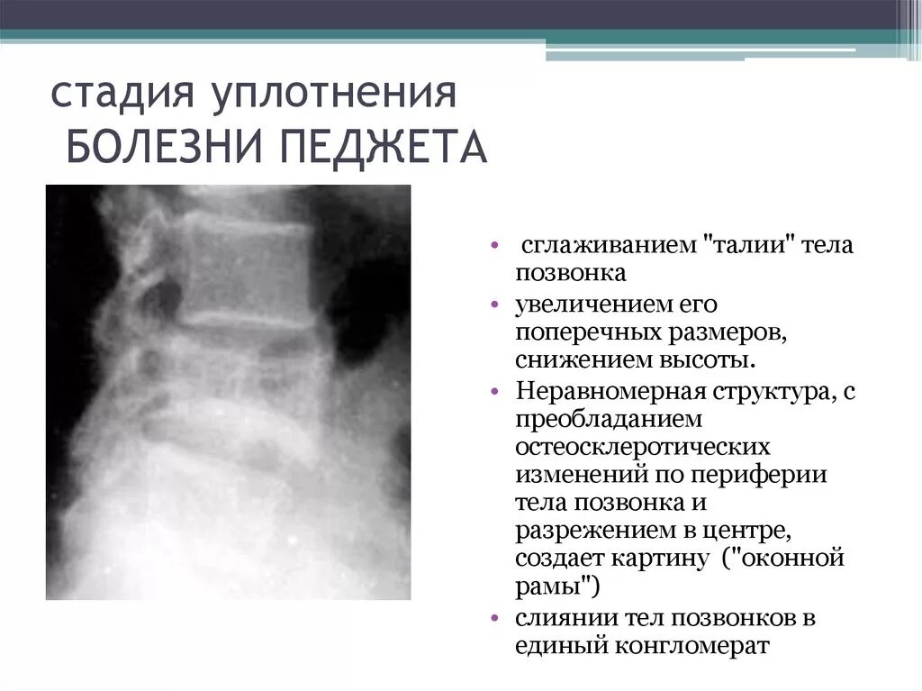 Рак педжета фото начальная стадия Болезнь Педжета (деформирующий остит) - презентация онлайн