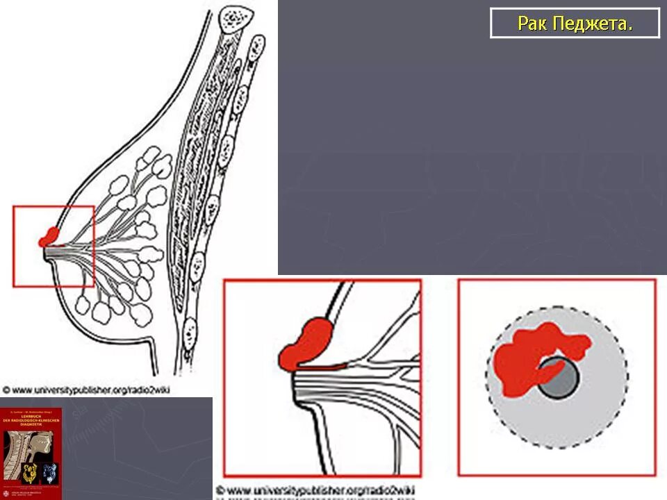 Рак педжета фото начальная стадия Молочная железа. Онк. Зл. Педжета рак. + Портал радиологов